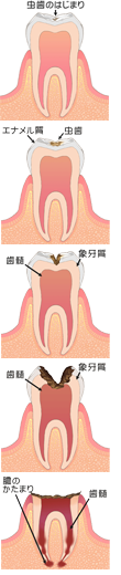 虫歯の流れ