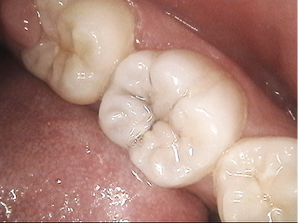 虫歯例